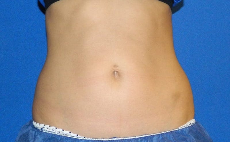 CoolSculpting Before & After Gallery - Patient 178176 - Image 2
