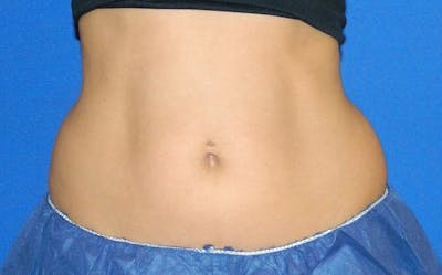 CoolSculpting Before & After Gallery - Patient 178176 - Image 1