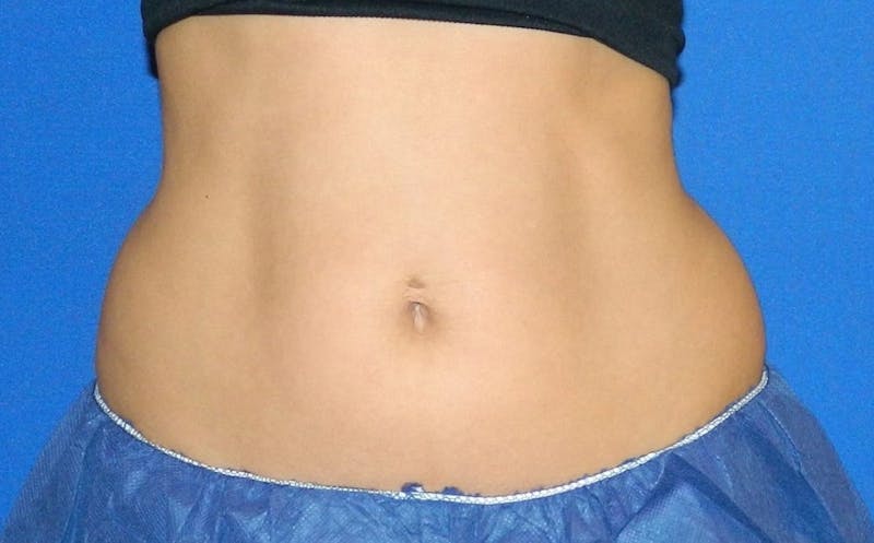 CoolSculpting Before & After Gallery - Patient 178176 - Image 1