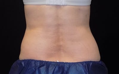 CoolSculpting Before & After Gallery - Patient 215060 - Image 2