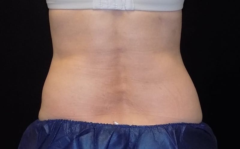 CoolSculpting Before & After Gallery - Patient 215060 - Image 2