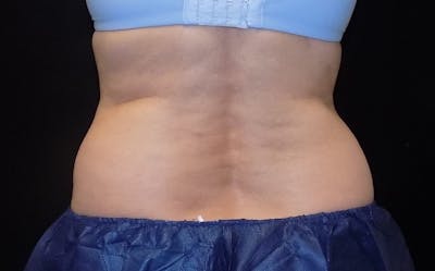 CoolSculpting Before & After Gallery - Patient 215060 - Image 1