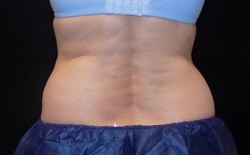 CoolSculpting Before & After Gallery - Patient 215060 - Image 1
