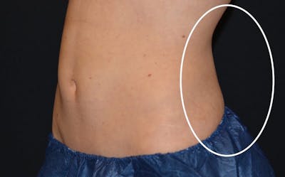 CoolSculpting Before & After Gallery - Patient 576658 - Image 2