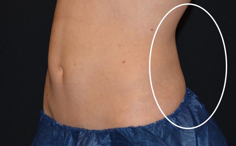CoolSculpting Before & After Gallery - Patient 576658 - Image 2