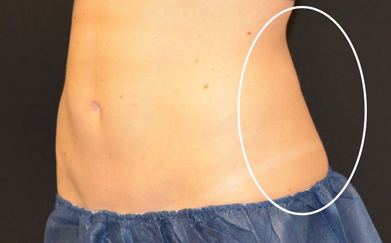 CoolSculpting Before & After Gallery - Patient 576658 - Image 1