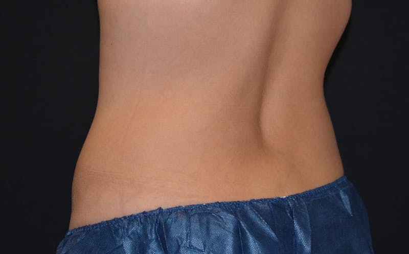 CoolSculpting Before & After Gallery - Patient 217938 - Image 2