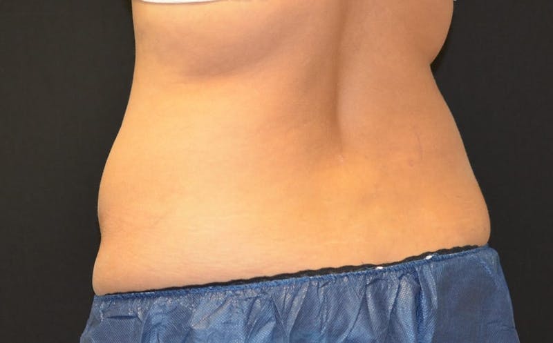 CoolSculpting Before & After Gallery - Patient 217938 - Image 1