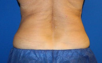CoolSculpting Before & After Gallery - Patient 317966 - Image 2