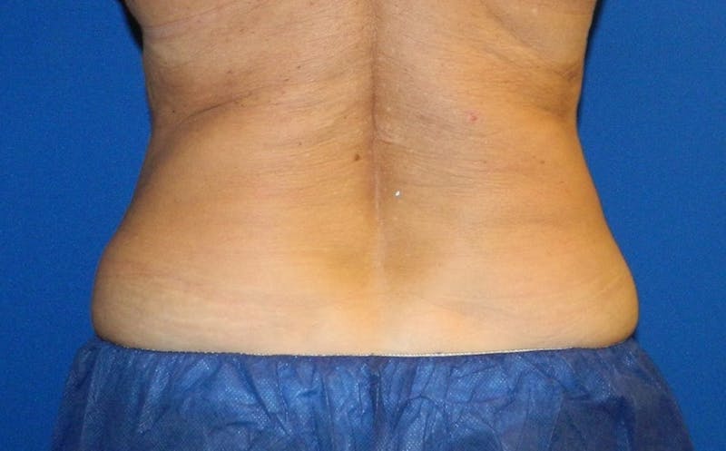 CoolSculpting Before & After Gallery - Patient 317966 - Image 2