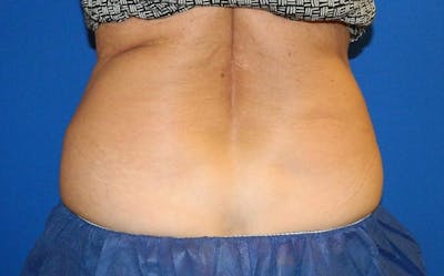 CoolSculpting Before & After Gallery - Patient 317966 - Image 1
