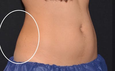 CoolSculpting Before & After Gallery - Patient 206888 - Image 2