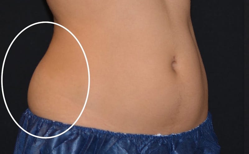 CoolSculpting Before & After Gallery - Patient 206888 - Image 1