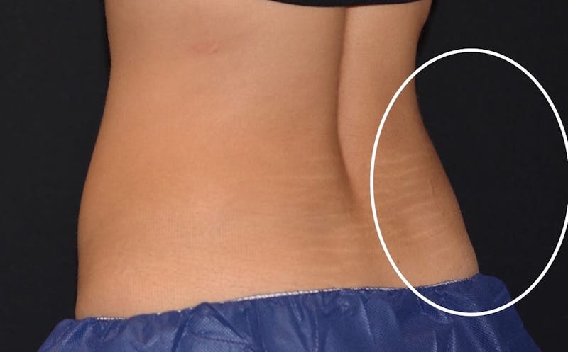 CoolSculpting Before & After Gallery - Patient 206888 - Image 4