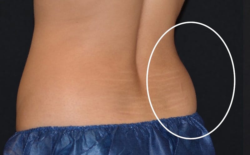 CoolSculpting Before & After Gallery - Patient 206888 - Image 3