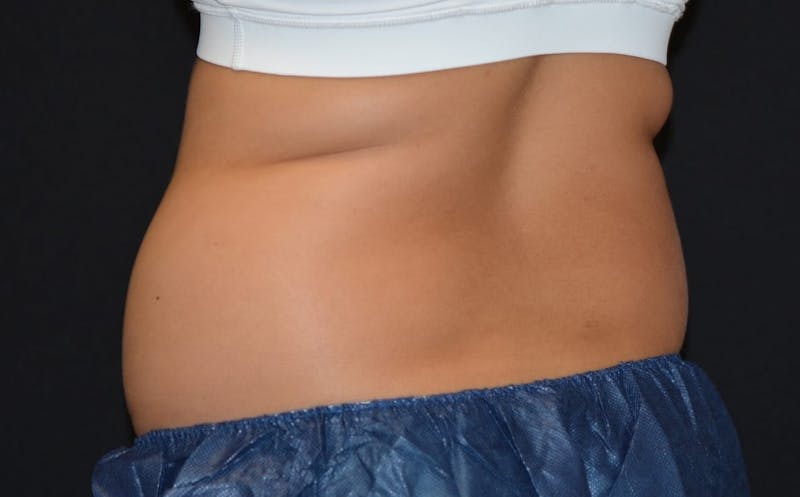 CoolSculpting Before & After Gallery - Patient 250179 - Image 1