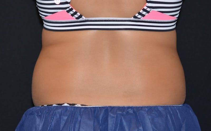 CoolSculpting Before & After Gallery - Patient 250179 - Image 4