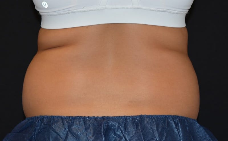 CoolSculpting Before & After Gallery - Patient 250179 - Image 3