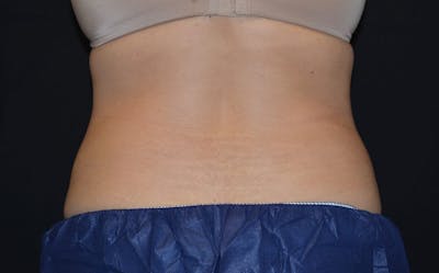 CoolSculpting Before & After Gallery - Patient 205052 - Image 2
