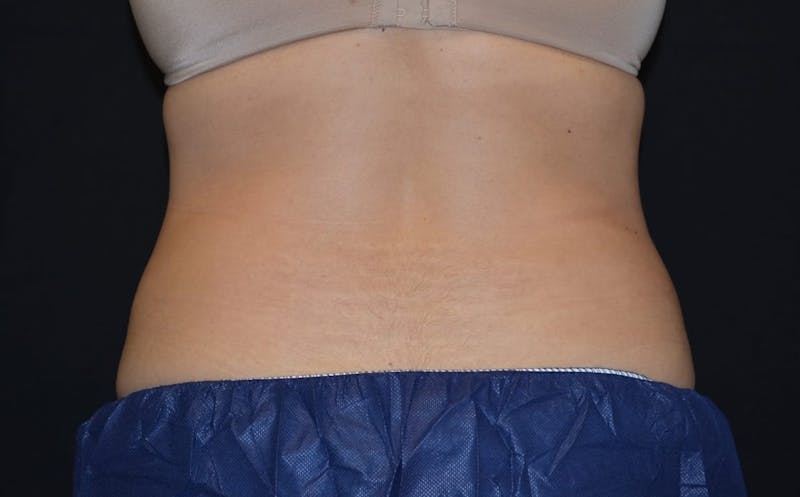 CoolSculpting Before & After Gallery - Patient 205052 - Image 2