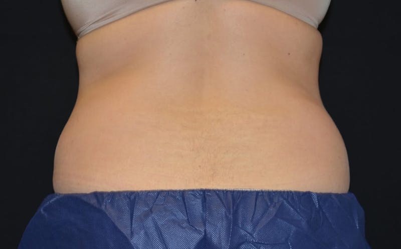 CoolSculpting Before & After Gallery - Patient 205052 - Image 1