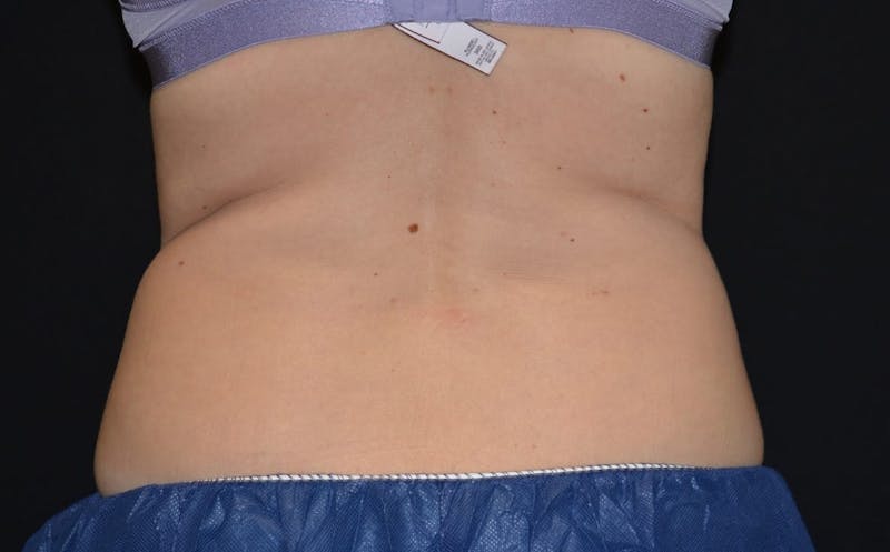 CoolSculpting Before & After Gallery - Patient 402252 - Image 2