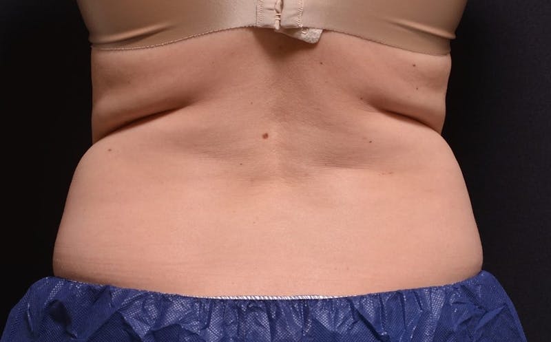 CoolSculpting Before & After Gallery - Patient 402252 - Image 1
