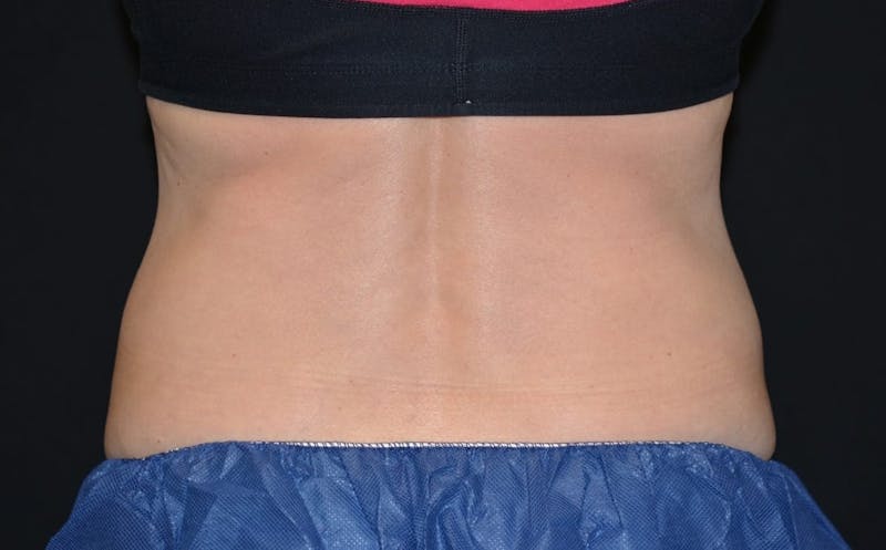 CoolSculpting Before & After Gallery - Patient 206291 - Image 2