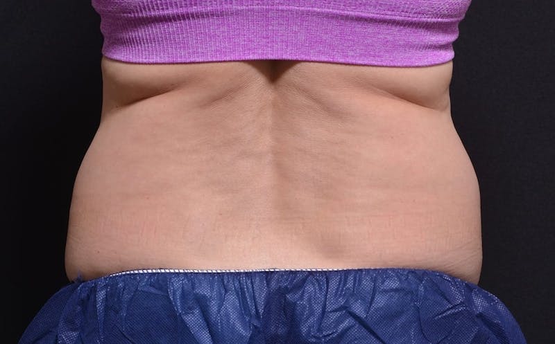CoolSculpting Before & After Gallery - Patient 206291 - Image 1