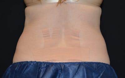 CoolSculpting Before & After Gallery - Patient 557069 - Image 2