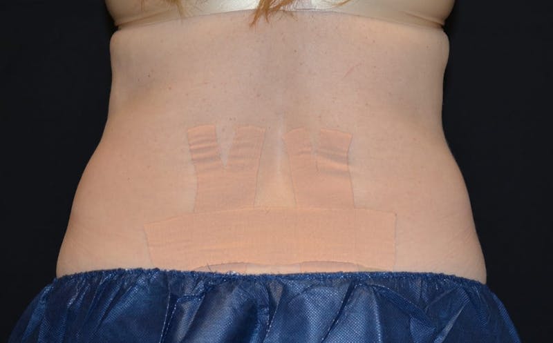 CoolSculpting Before & After Gallery - Patient 557069 - Image 2