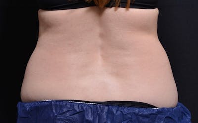 CoolSculpting Before & After Gallery - Patient 557069 - Image 1