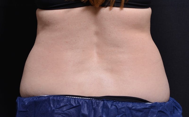 CoolSculpting Before & After Gallery - Patient 557069 - Image 1
