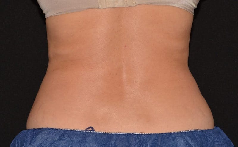 CoolSculpting Before & After Gallery - Patient 349456 - Image 2