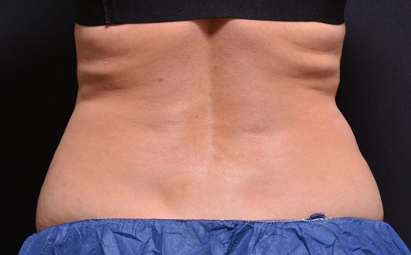 CoolSculpting Before & After Gallery - Patient 349456 - Image 1