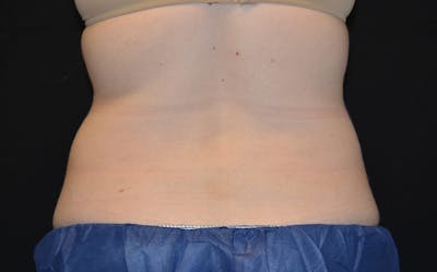 CoolSculpting Before & After Gallery - Patient 408024 - Image 2
