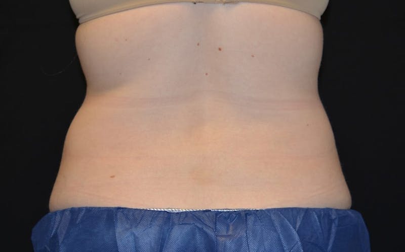 CoolSculpting Before & After Gallery - Patient 408024 - Image 2