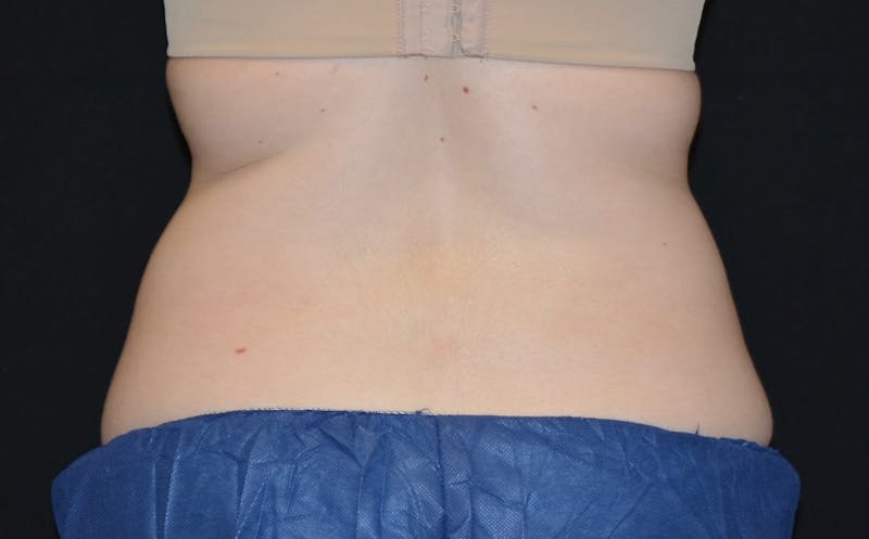 CoolSculpting Before & After Gallery - Patient 408024 - Image 1