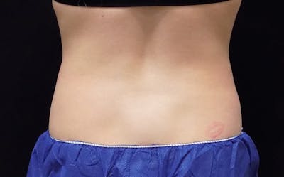 CoolSculpting Before & After Gallery - Patient 249592 - Image 2