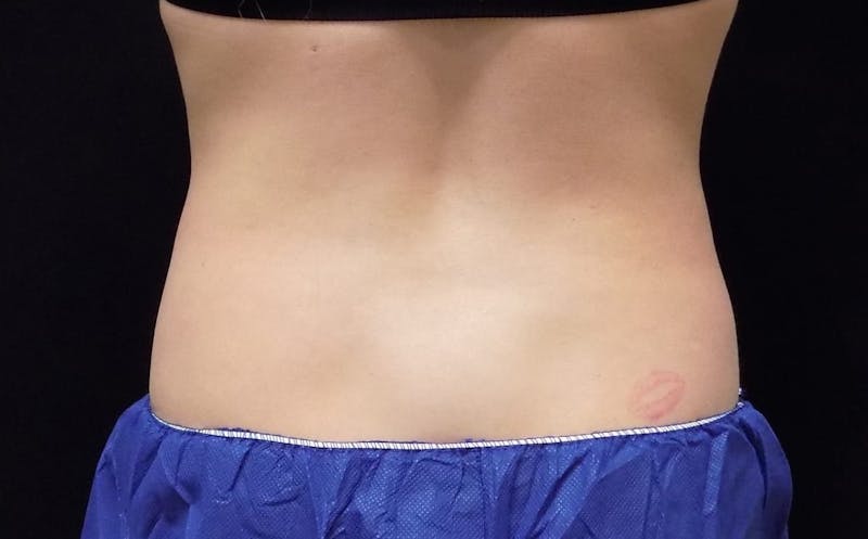 CoolSculpting Before & After Gallery - Patient 249592 - Image 2