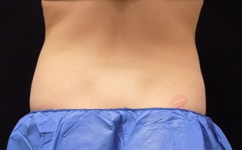 CoolSculpting Before & After Gallery - Patient 249592 - Image 1