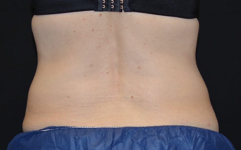 CoolSculpting Before & After Gallery - Patient 133414 - Image 2