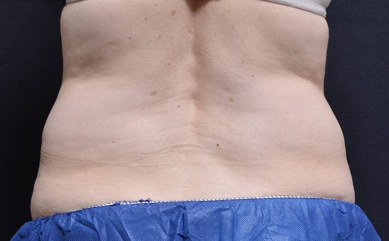 CoolSculpting Before & After Gallery - Patient 133414 - Image 1