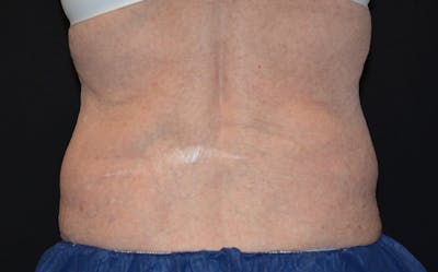 CoolSculpting Before & After Gallery - Patient 177301 - Image 2