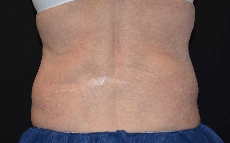 CoolSculpting Before & After Gallery - Patient 177301 - Image 2