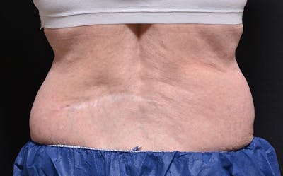 CoolSculpting Before & After Gallery - Patient 177301 - Image 1