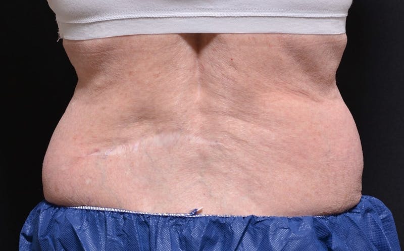 CoolSculpting Before & After Gallery - Patient 177301 - Image 1