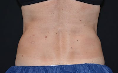 CoolSculpting Before & After Gallery - Patient 403946 - Image 2