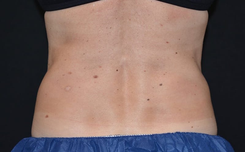 CoolSculpting Before & After Gallery - Patient 403946 - Image 2