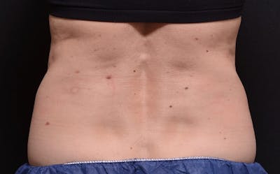 CoolSculpting Before & After Gallery - Patient 403946 - Image 1